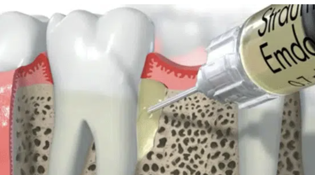 Régénération parodontale