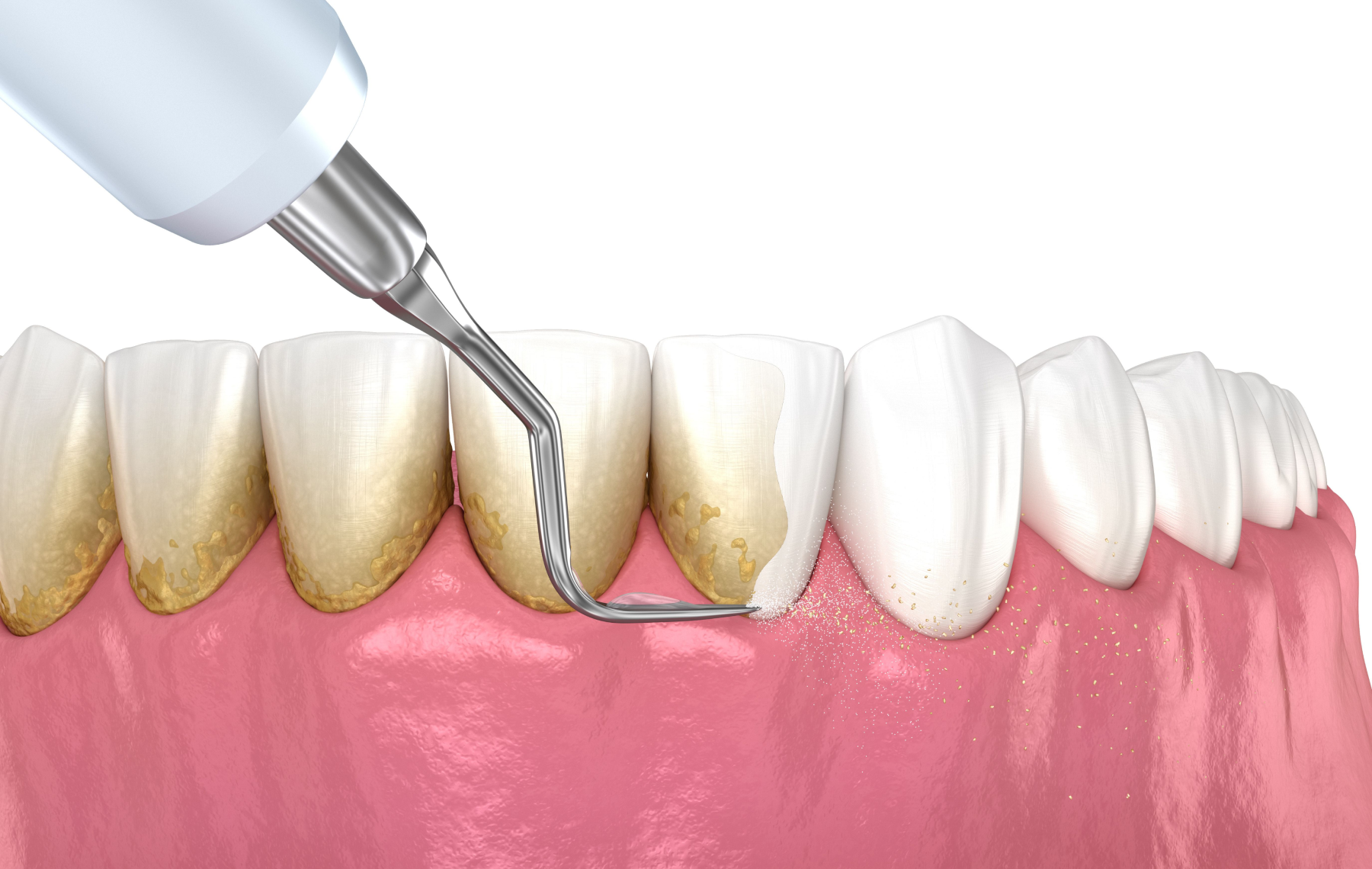 Traitement non-chirurgical