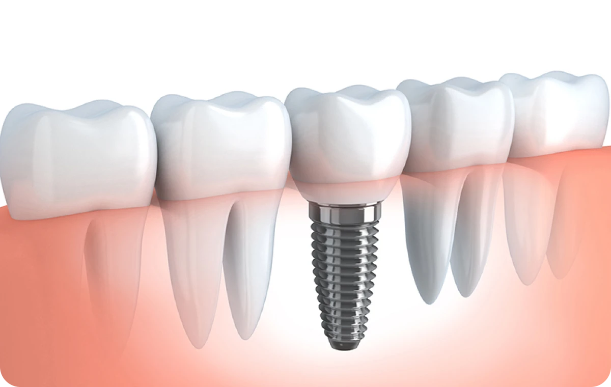 Implants dentaires