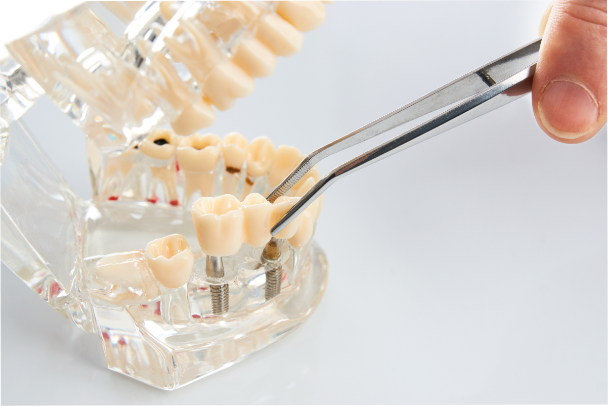 Réhabilitation globale sur implants