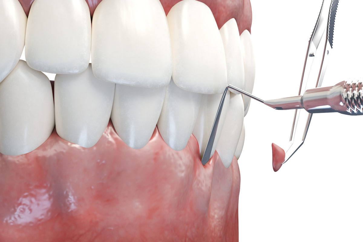 Récession gingivale